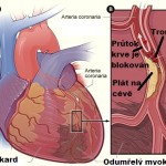 Akutní infarkt myokardu Akutni infarkt myokardu, srdeční infarkt