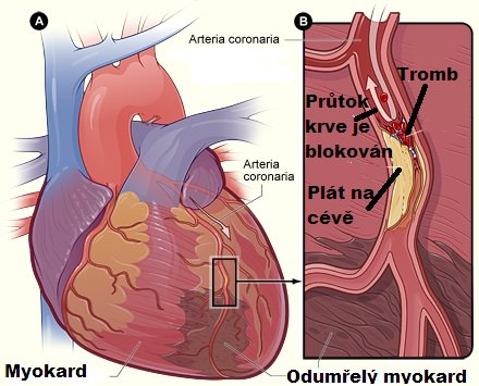Akutni infarkt myokardu, srdeční infarkt
