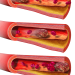 Hormonální antikoncepce Hormonální antikoncepce, tromboembolická nemoc, trombofilie