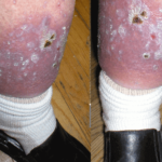 Bércový vřed Leg_ulcer